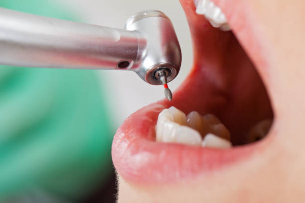 Best Dental Abscess Treatment in Belfair, WA